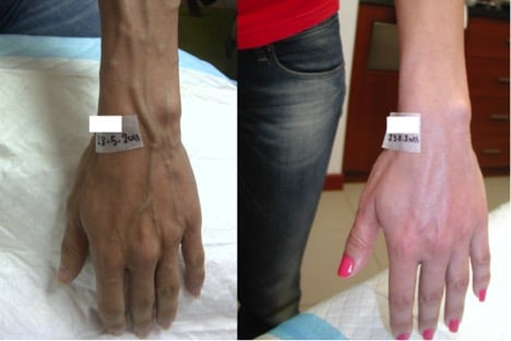 How To Make Your Hands Look Younger Dubai Uae Shamma Clinic