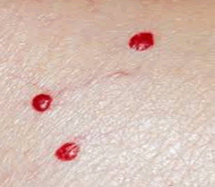 cherry-hemangioma