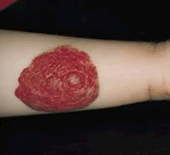 strawberry-hemangioma-300x218