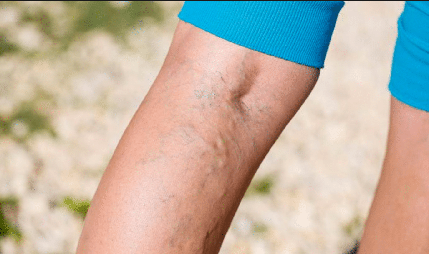 Varicose Vein Stripping Treatment vs. Sclerotherapy: Goldman Vein