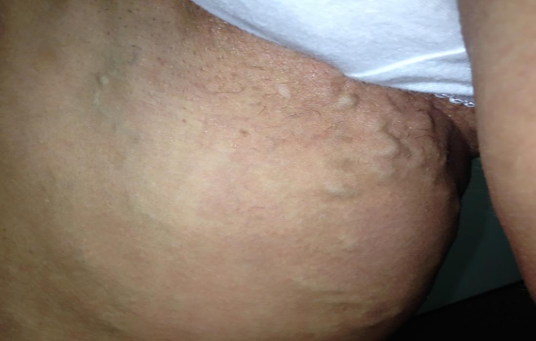 Varicose Veins Of Vagina And Vulva