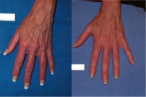 How To Make Your Hands Look Younger Dubai Uae Shamma Clinic