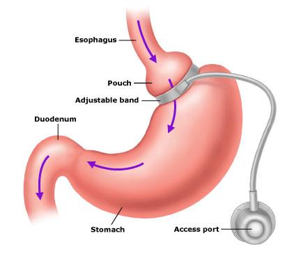 gastric band